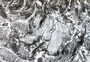 F,27y. | endomyocardial fibrosis